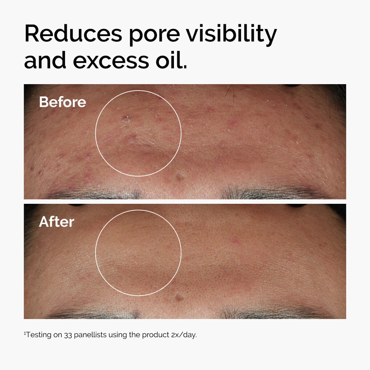 niacinamide-10-zinc-1-p4 ord-niacinamide-zinc-blemish-serum-before-after-pores.jpg