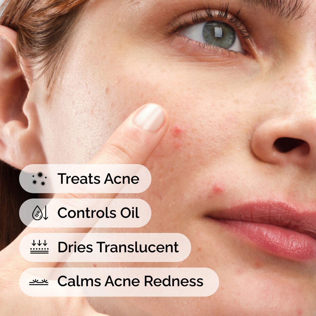 sulfur-10-powder-to-cream-concentrate-q2 ord-sulfur-10pct-powder-to-cream-concentrate-model-application-with-benefits-acne.jpg