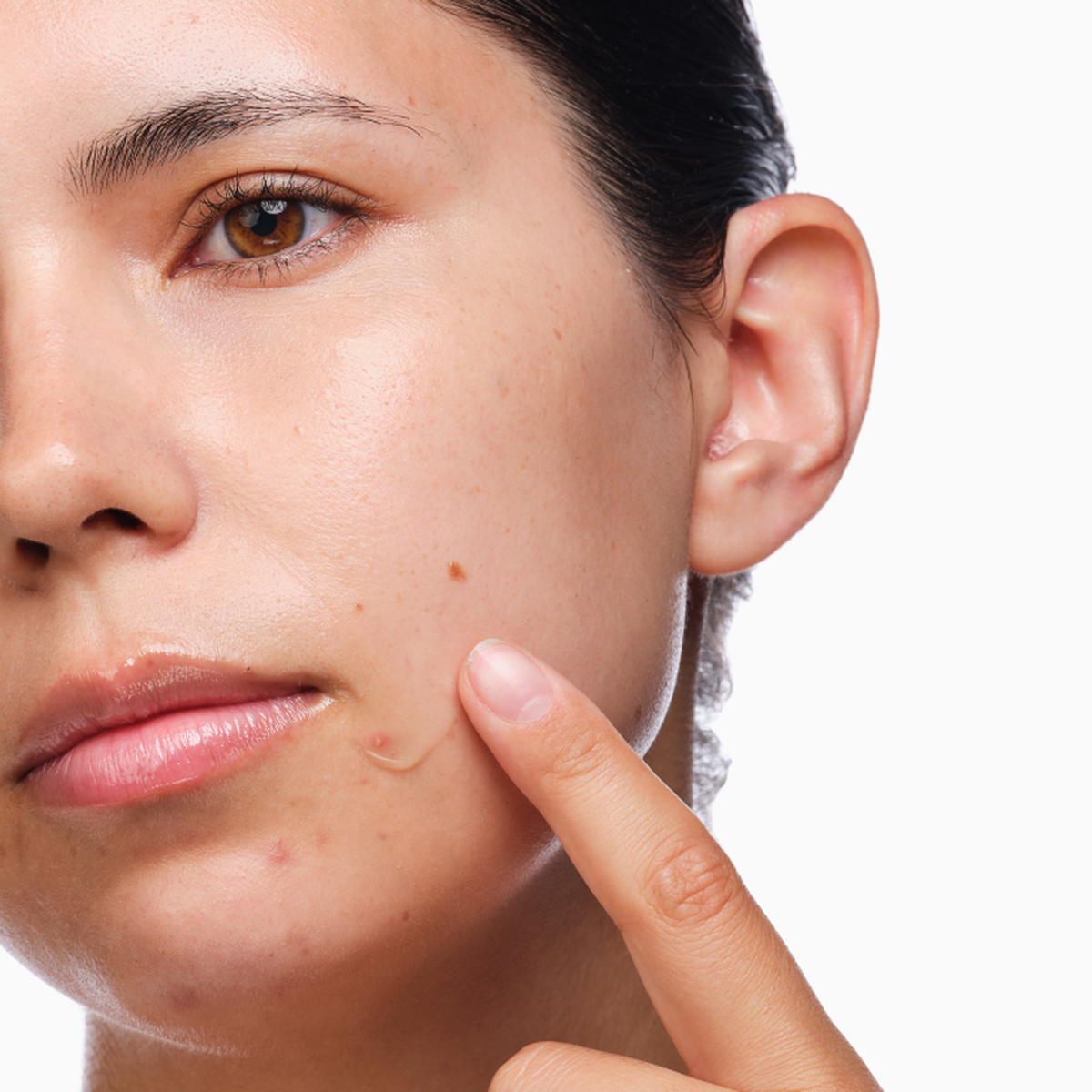 the-acne-set-u4 rdn-the-acne-set-application.png